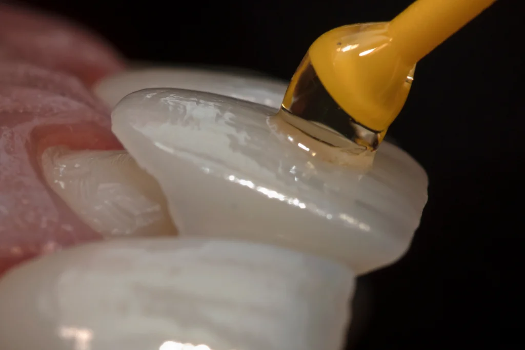 Personalized Veneer Treatment Pomona