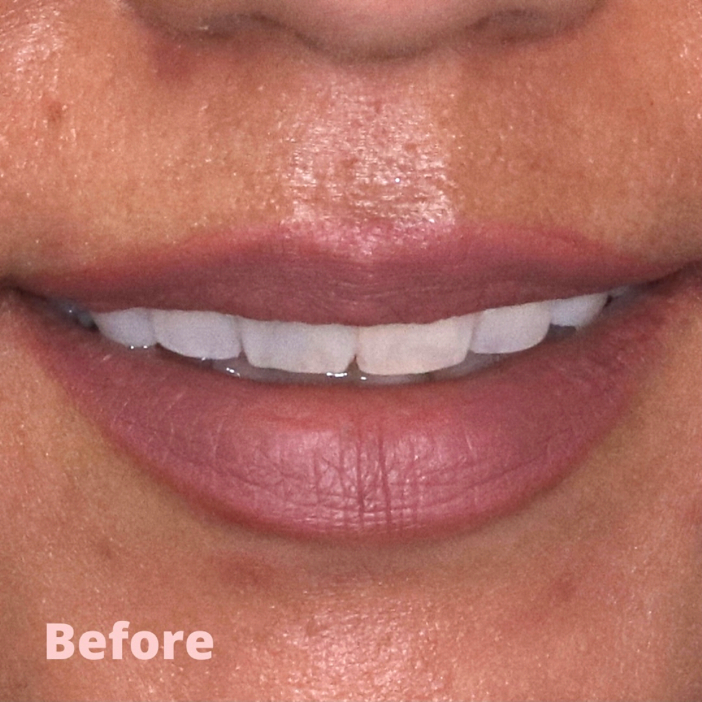 Dental Veneers in Pomona, CA