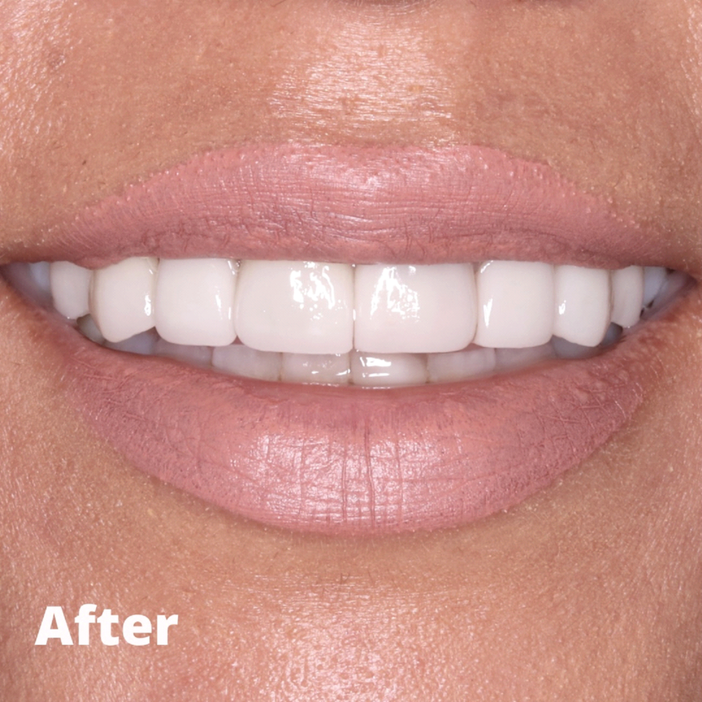 Dental Veneers in Pomona, CA